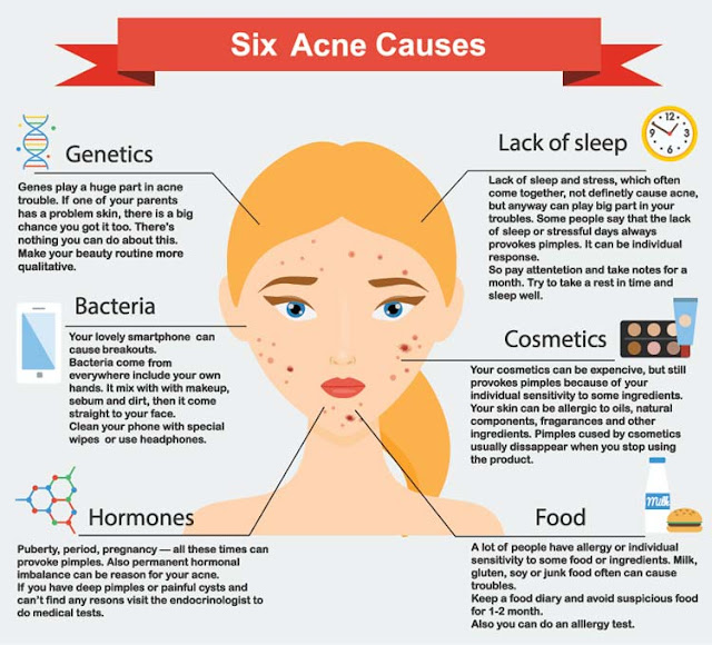 Acne Zones and Causes