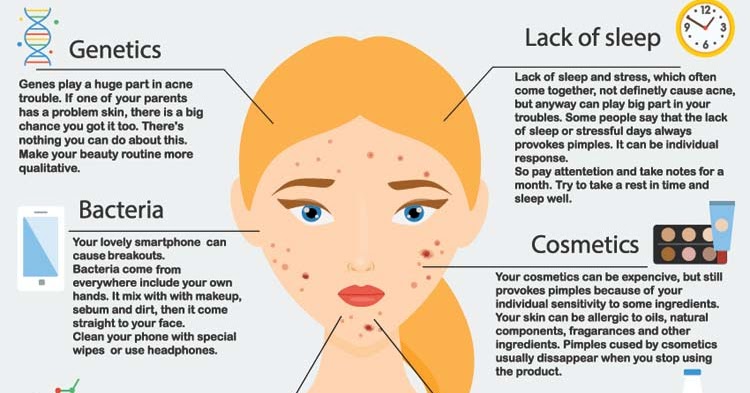 Acne Zones and Causes