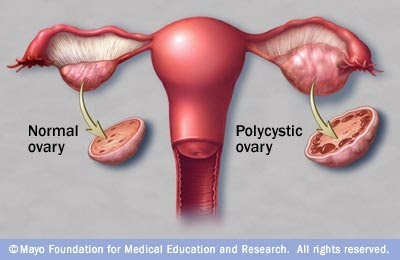 Normal Ovary vs Polycystic Ovary - PCOS