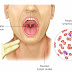 8 DANGEROUS DISEASES CAUSED BY KISSING YOU MUST KNOW