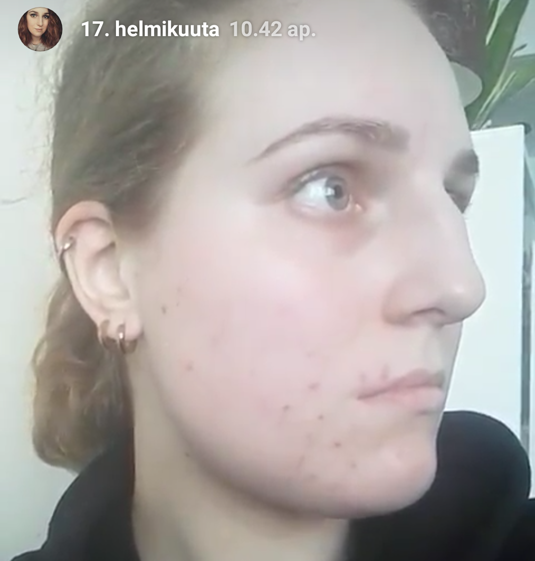dating vaikea akne