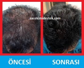 saç mezoterapisi öncesi ve sonrası 5