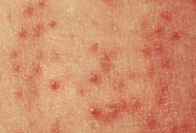 folliculitis pityrosporum forehead clogged