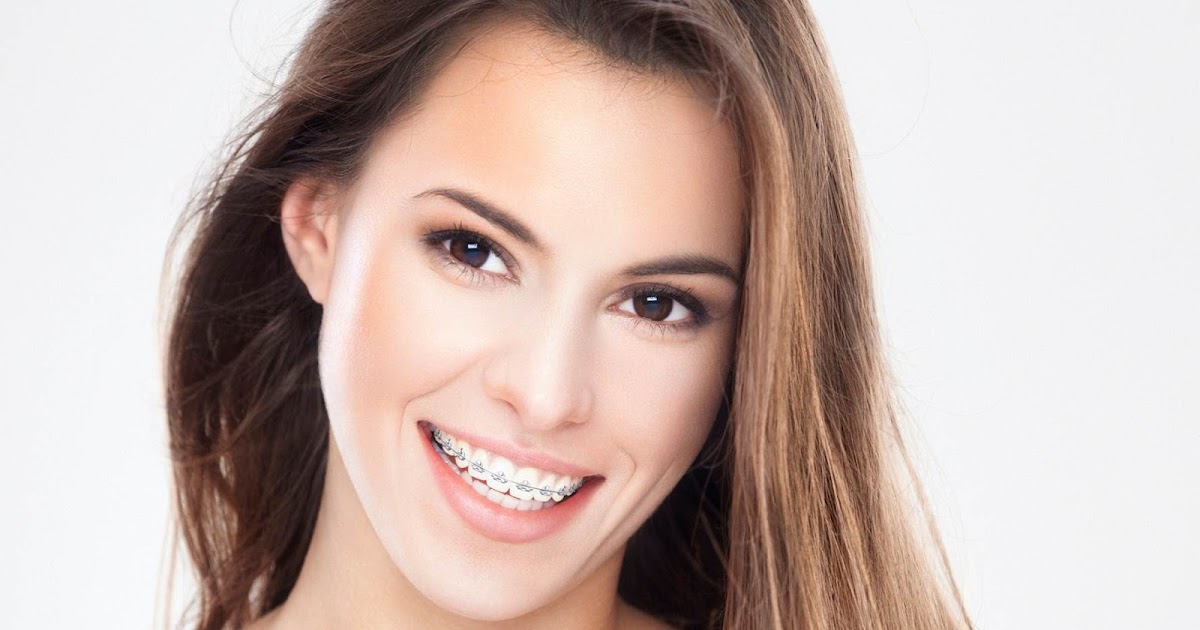 
How To Look Your Best With Braces | Diva Likes
