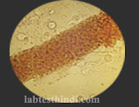 Urine Microscopic -RBC casts