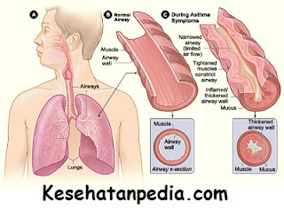 2 cara mengatasi penyakit asma secara tradisional