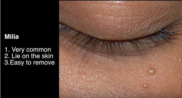 Cara Menghilangkan Milia Di Kelopak Mata - Berbagai Mata