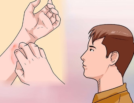 Top 3 Cheap & Effective Ways to get rid of Hives at Home - Medical Article