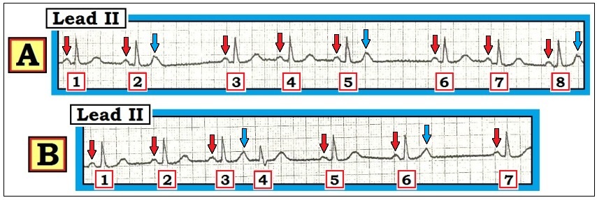 ECG Interpretation: ECG Interpretation Review #66 (2nd Degree AV Block ...