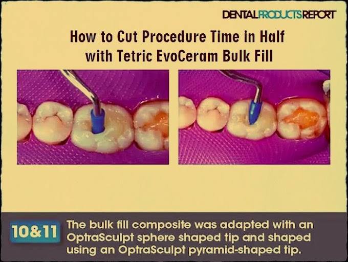 COMPOSITE RESTORATION: How to Cut Procedure Time in Half with Tetric EvoCeram Bulk Fill