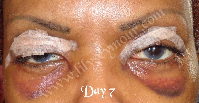 African American Ethnic Blepharoplasty Eyelid Surgery
