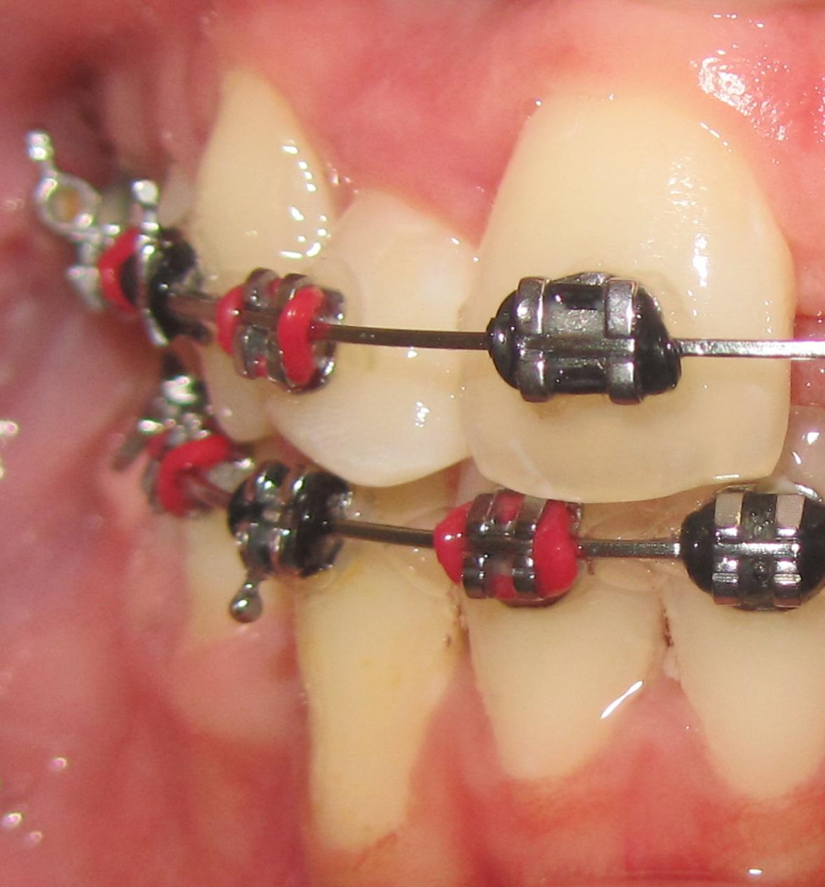 practical orthodontics Anterior labial root torque