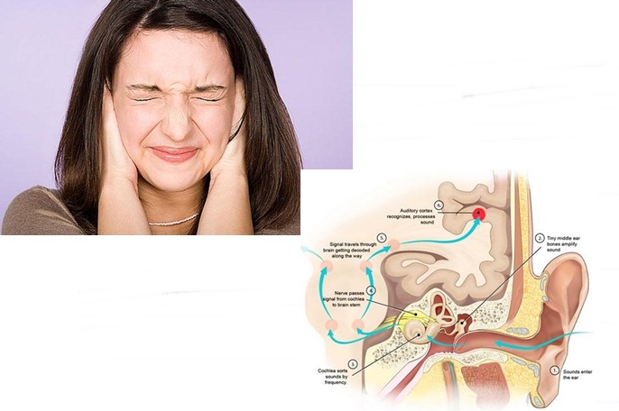 Pengobatan Untuk Mengatasi Telinga Berdengung (Tinnitus) Secara Efektif