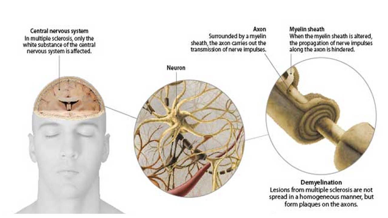 общемозговой синдром. рассеянный склероз. головные боли при рассеянном склерозе. клинические проявления рассеянного склероза. профилактика рассеянного склероза.