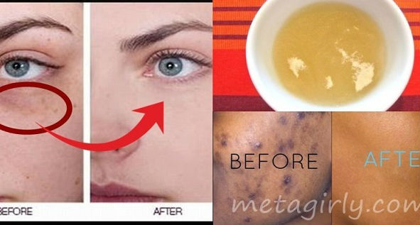 Khabaruna Singkirkan Flek Hitam Di Wajah Hanya Dalam 30 Menit