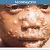 (MUST READ). MONKEYPOX DISEASES OUTBREAKS HITS NIGERIA, WHAT YOU NEED TO KNOW ABOUT THE DEADLY DISEASE.
