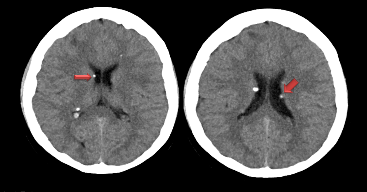Ultimate Radiology Plain CT Brain findings in an adolescent patient