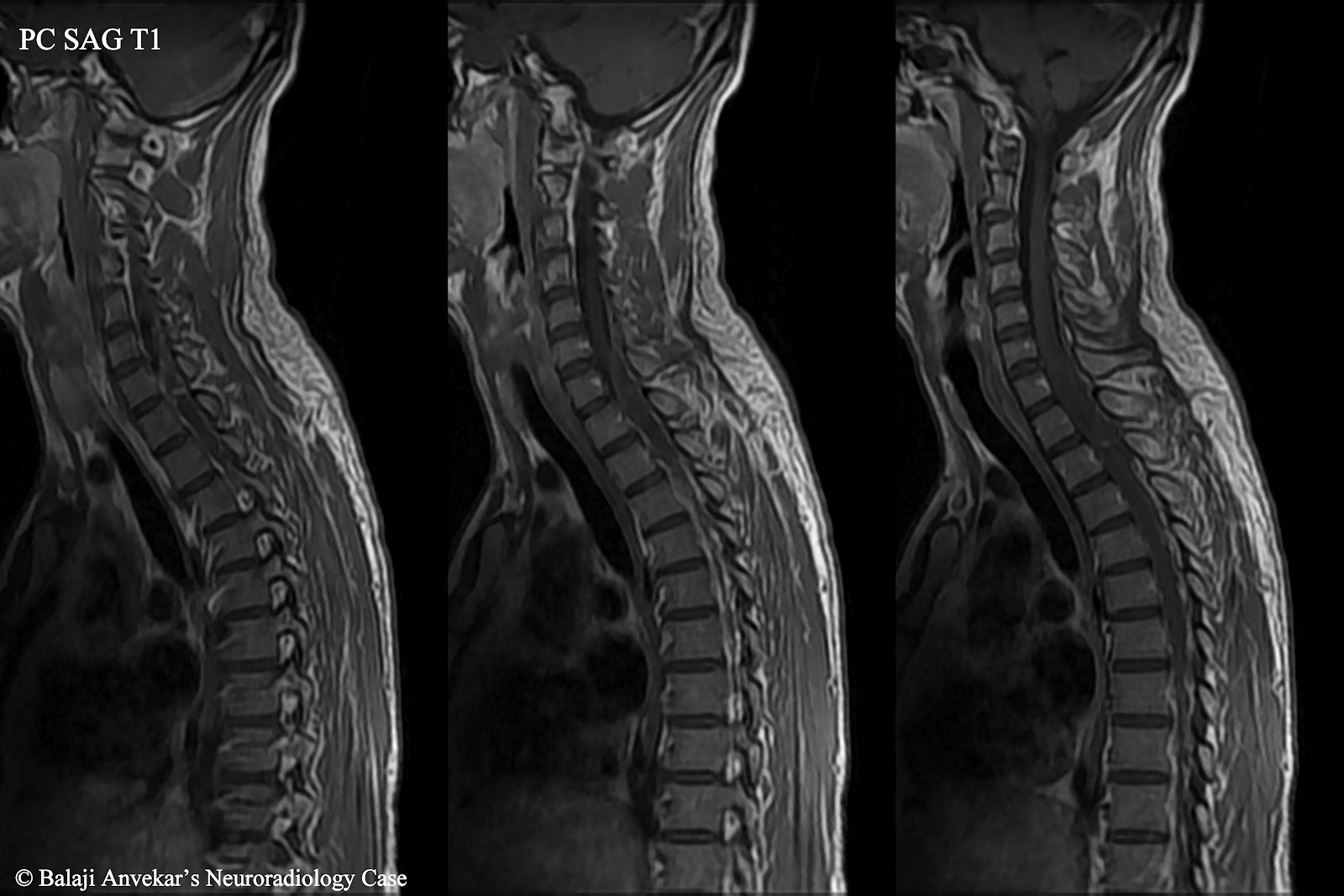 Lumbar Spine: Cpt Mri Lumbar Spine Without Contrast