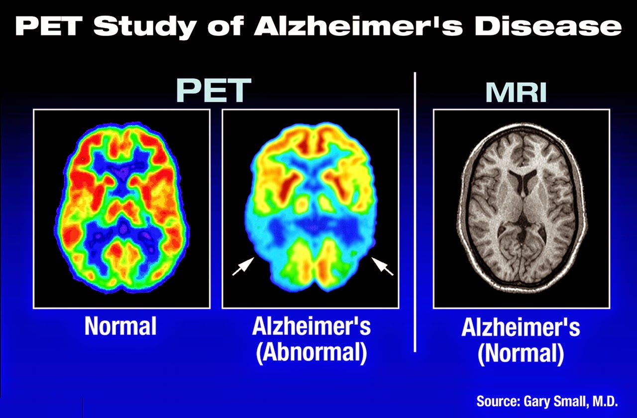 Enfermedad de Alzheimer octubre 2014