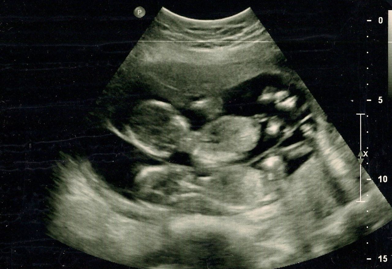 Забеременела в 20. УЗИ двойняшек на 20 неделе беременности. УЗИ двойни на 20 неделе беременности. УЗИ плода мальчика в 20 недель.