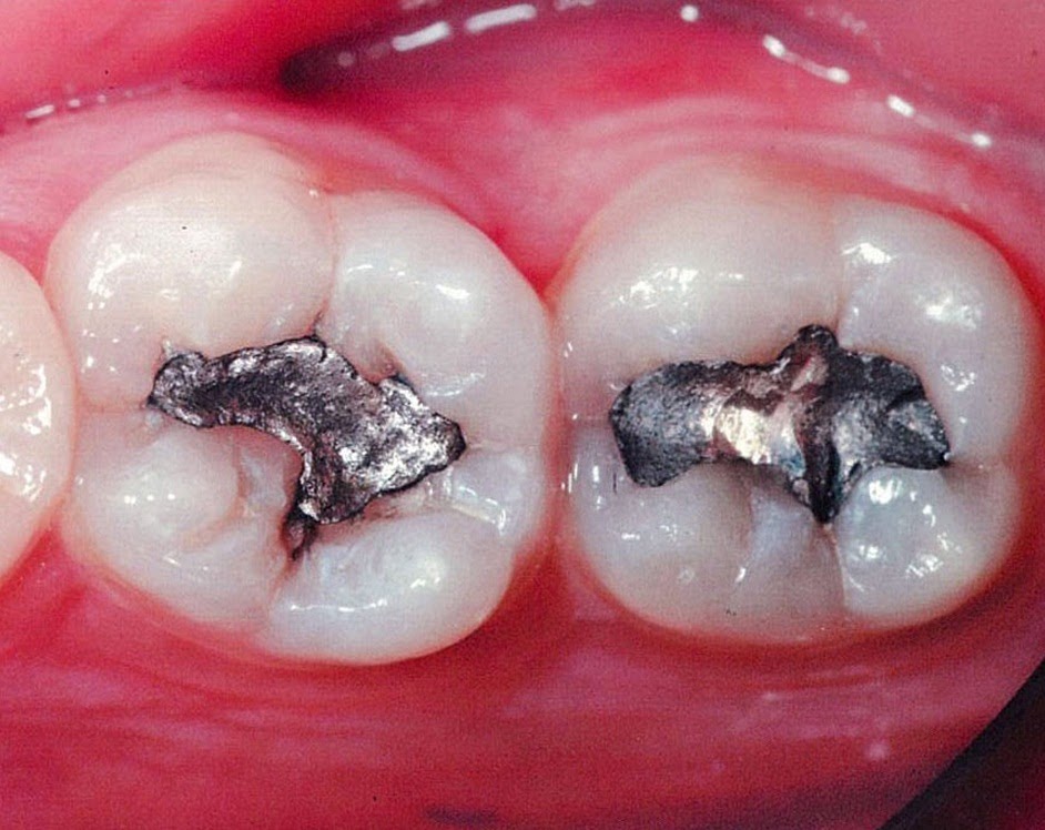 Odontin Amalgamas y su riesgo