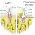 Freedom From Dental Disease - Tested and Proven