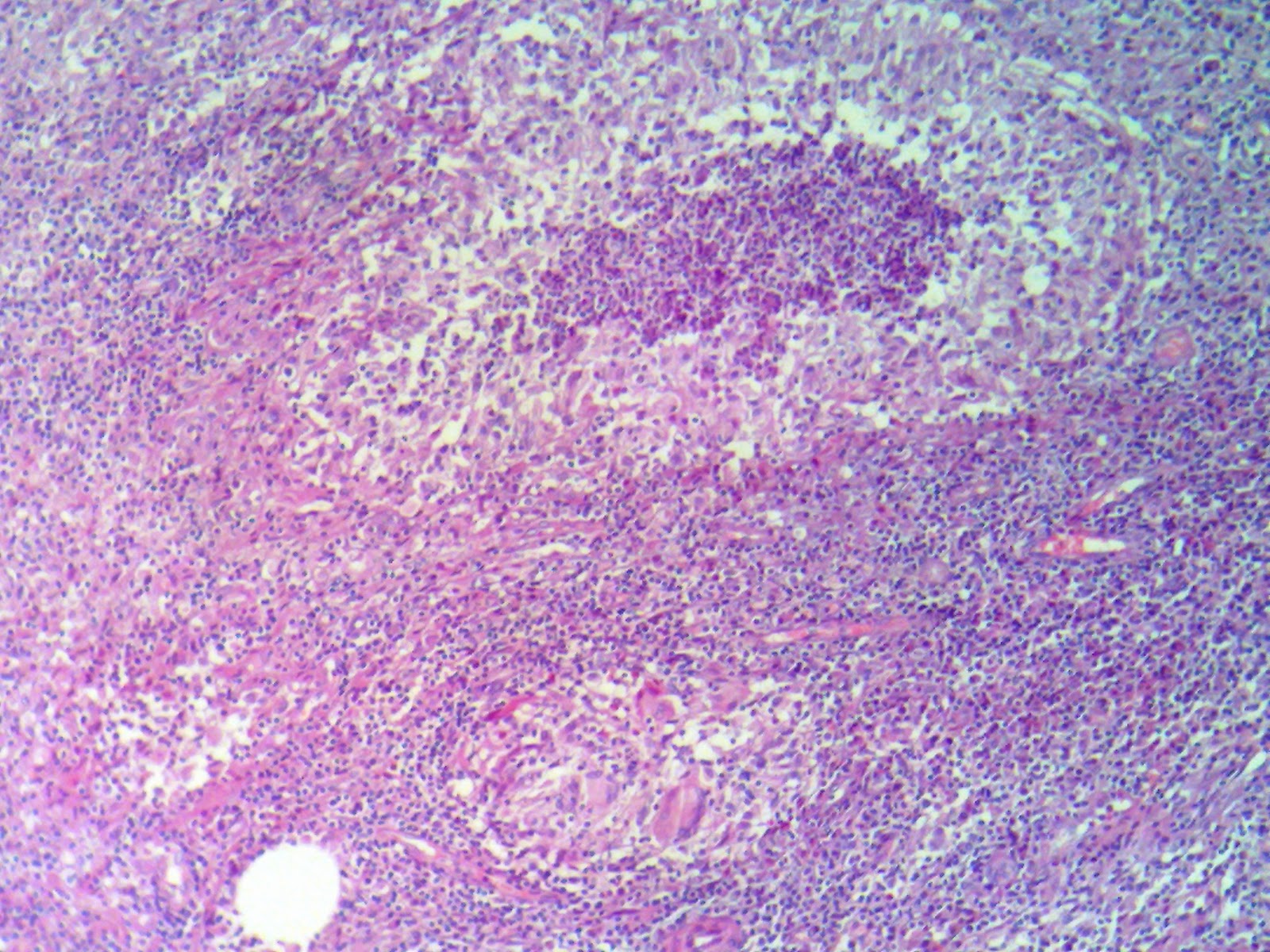 Многослойный плоский эпителий шейки матки гистология. Метаплазия матки гистология. Гистология 2 степени. Гистология 2 степени. Дисплазия шейки матки микропрепарат.