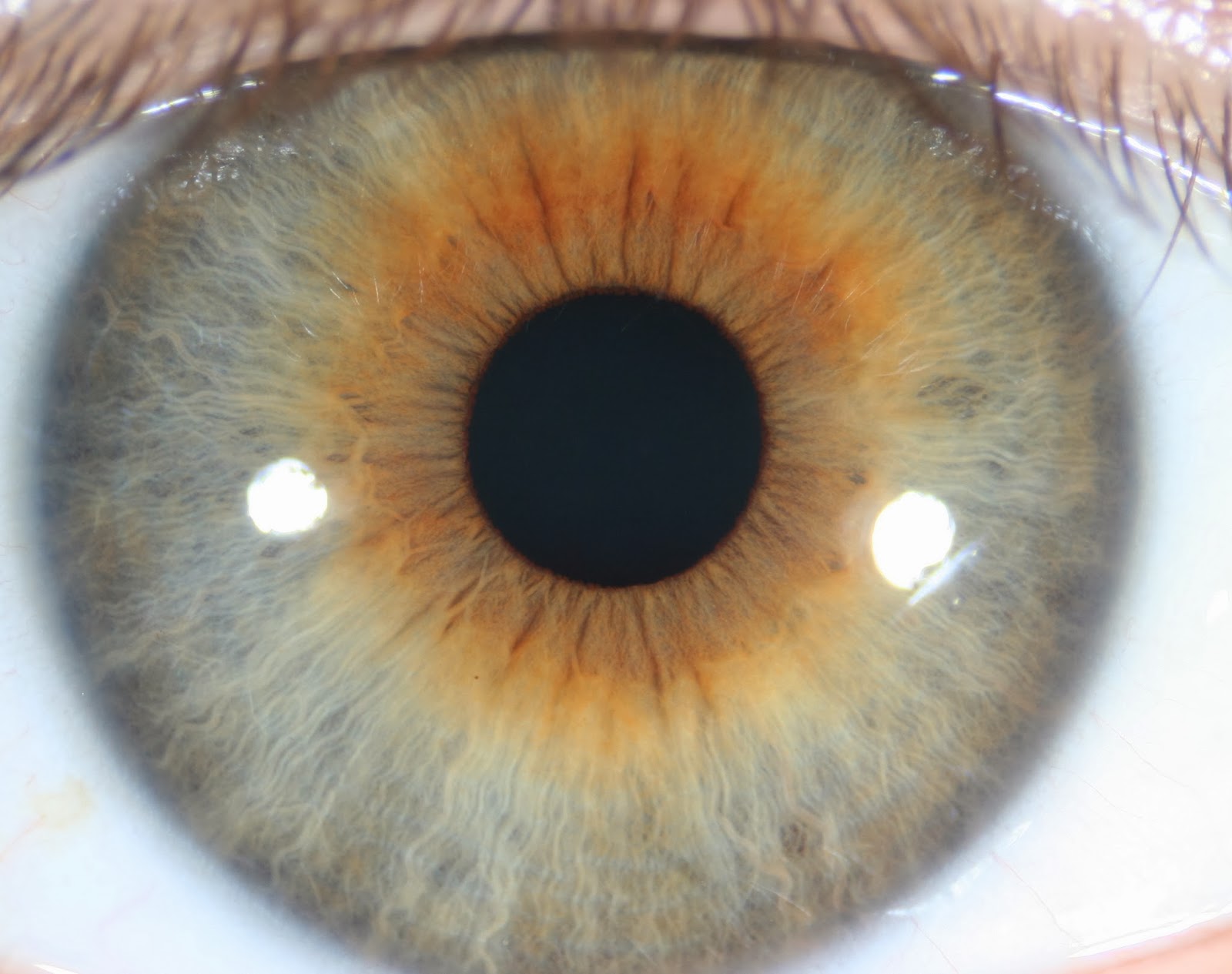 Modern & Multidimensional Iridology: Orange Central Heterochromia, Iris ...