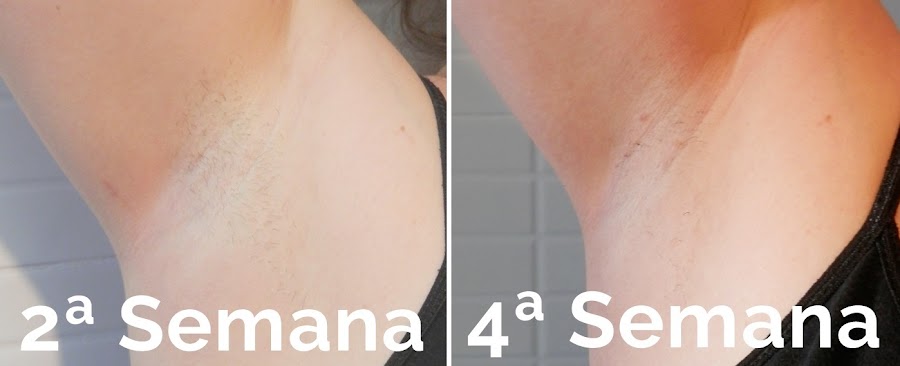 Depilacion IPL Philips Lumea antes después