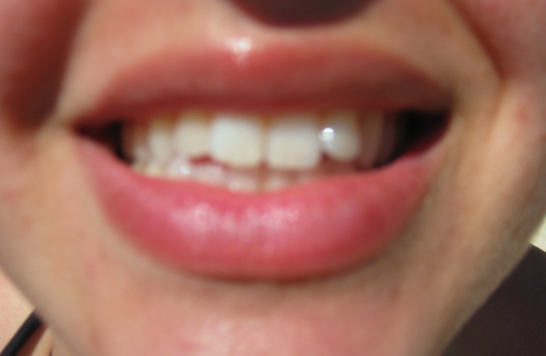 How do I get Whiter Teeth: Teeth Whitening - Testiomonials ...