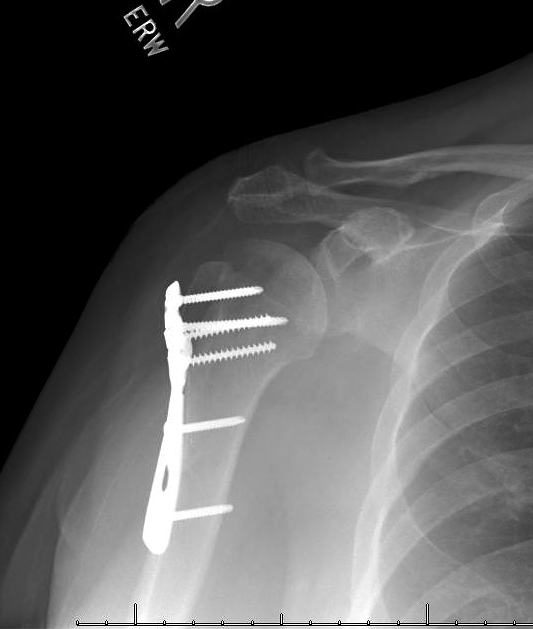Shoulder And Elbow Surgery Locked Proximal Humerus Fracture Dislocation ...