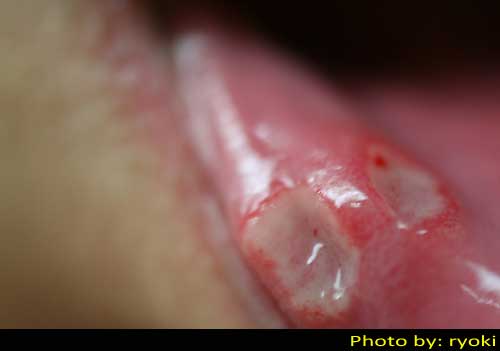 Mouth Ulcer Pictures - Symptoms, Photos, images and ...