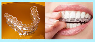 Niềng răng bằng nhựa cực hiệu quả thẩm mỹ cao