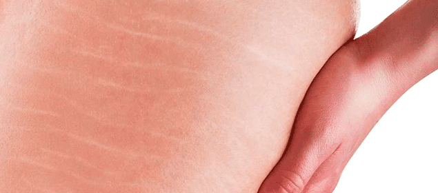 cómo eliminar las estrías