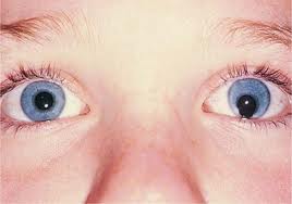 God's pocket: Bella's Eye Defect .....Coloboma!