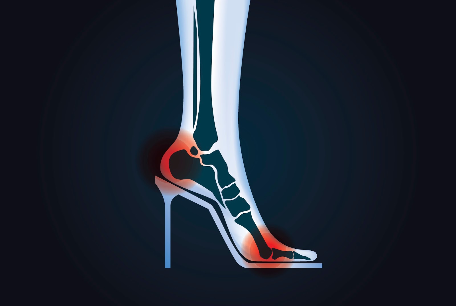High Heels - What happens to your feet | OrthoIndy Blog