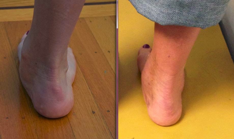 How Long Until You Can Walk After Acl Surgery