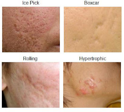 Sẹo mụn và cách điều trị hiệu quả