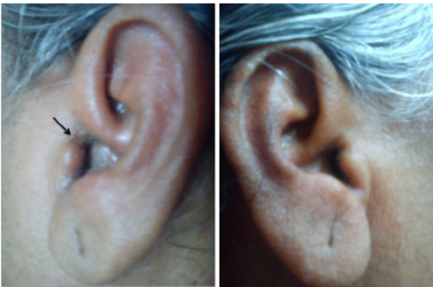 Otitis externa and facial swelling - Nude pics Cumshot on feet