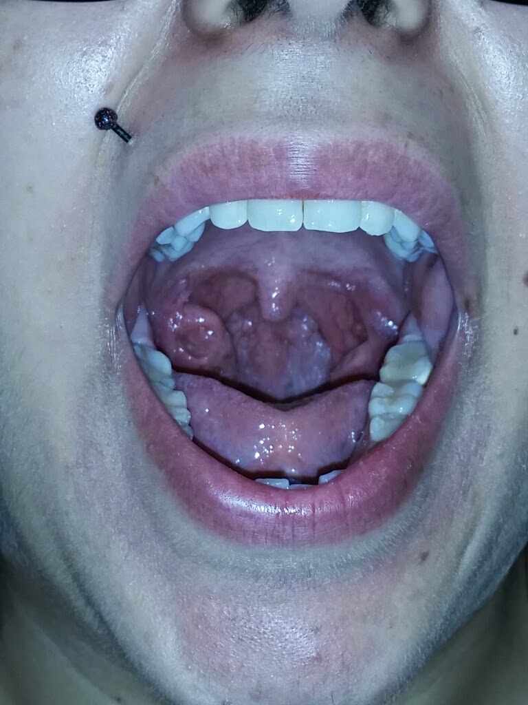 mono throat