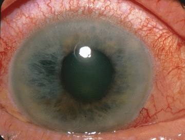 probabilitatea pierderii vederii la glaucom