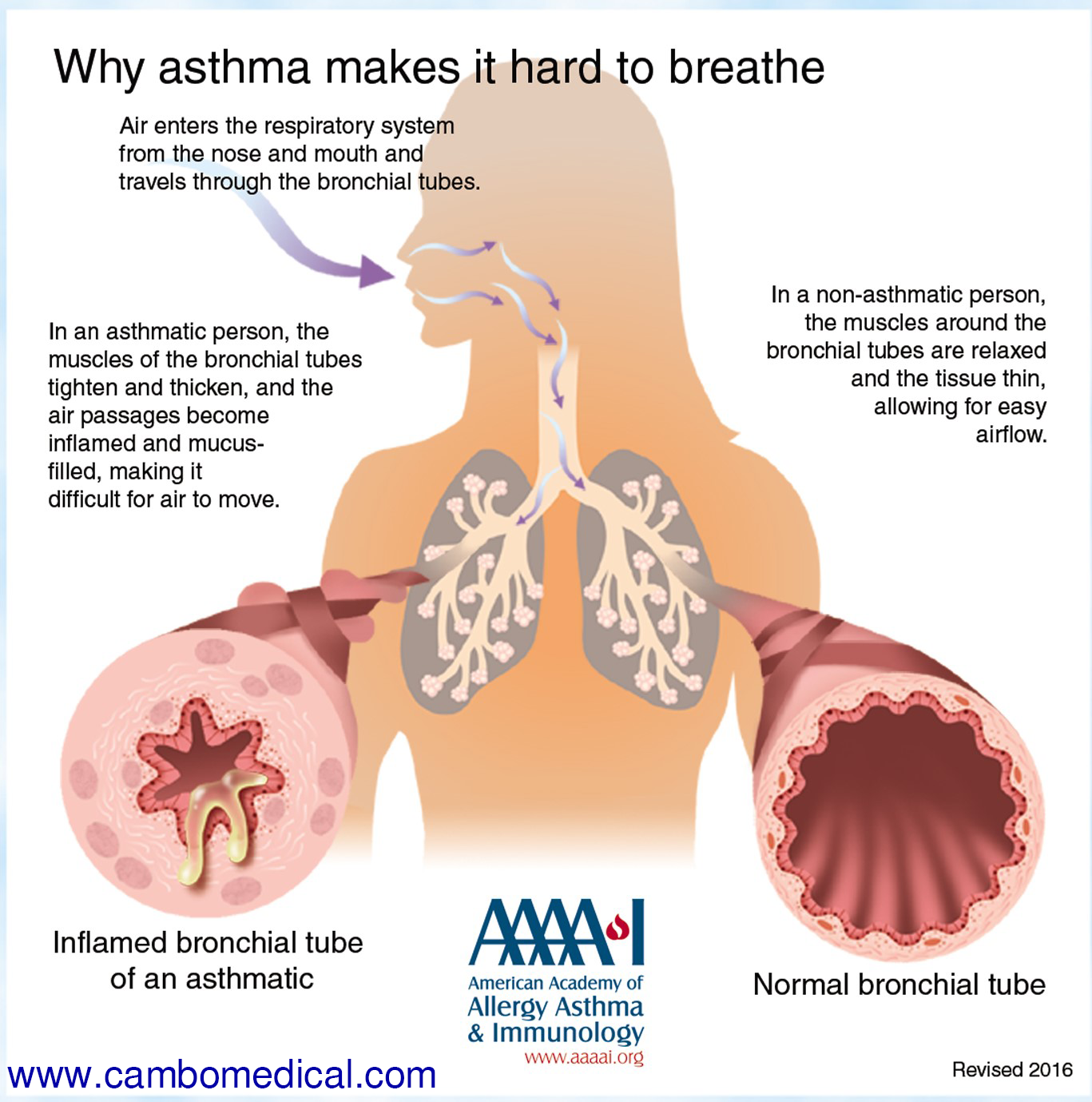 причины мокроты в бронхах