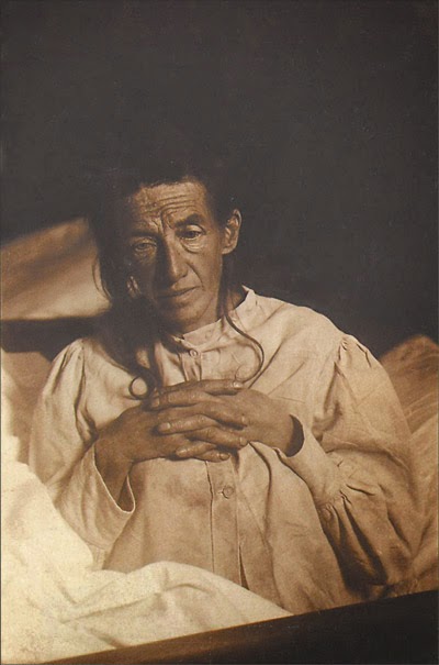 Photograph of Auguste Deter, the first patient to be diagnosed with Alzheimer's Disease