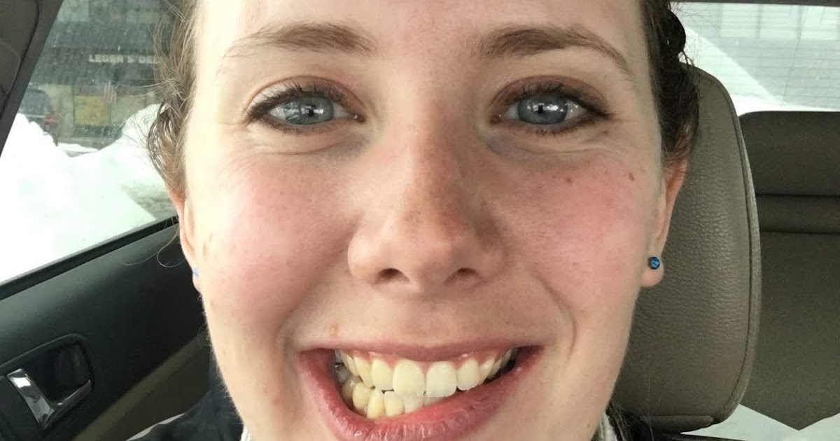 Double Jaw Surgery Root Canal