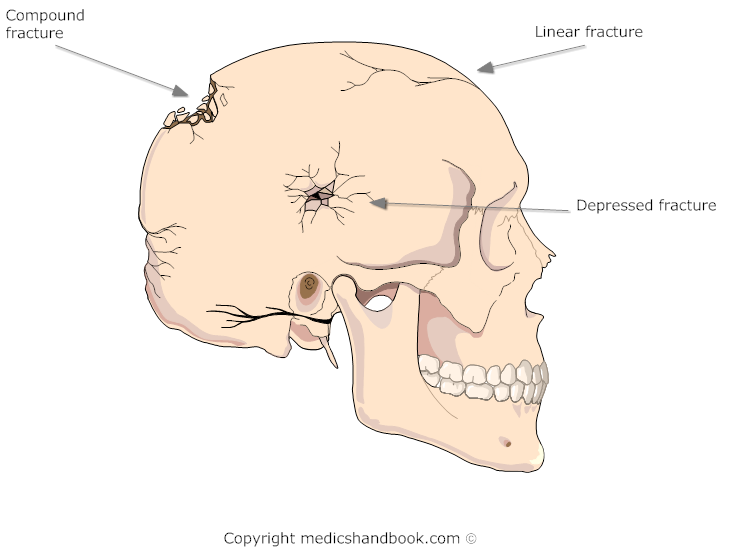 Череп разрыв. Дырчатый перелом костей черепа. Оскольчатый перелом костей черепа. Перелом свода черепа, перелом основания черепа. Оскольчатый перелом основания черепа.