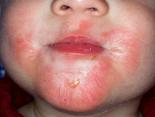 Dermatitis atópica 