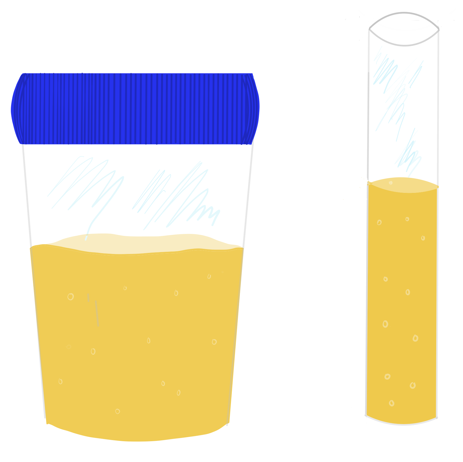 Decoding Bloody Urine: Hemolysis & Your Health Risks - dp5ju9r