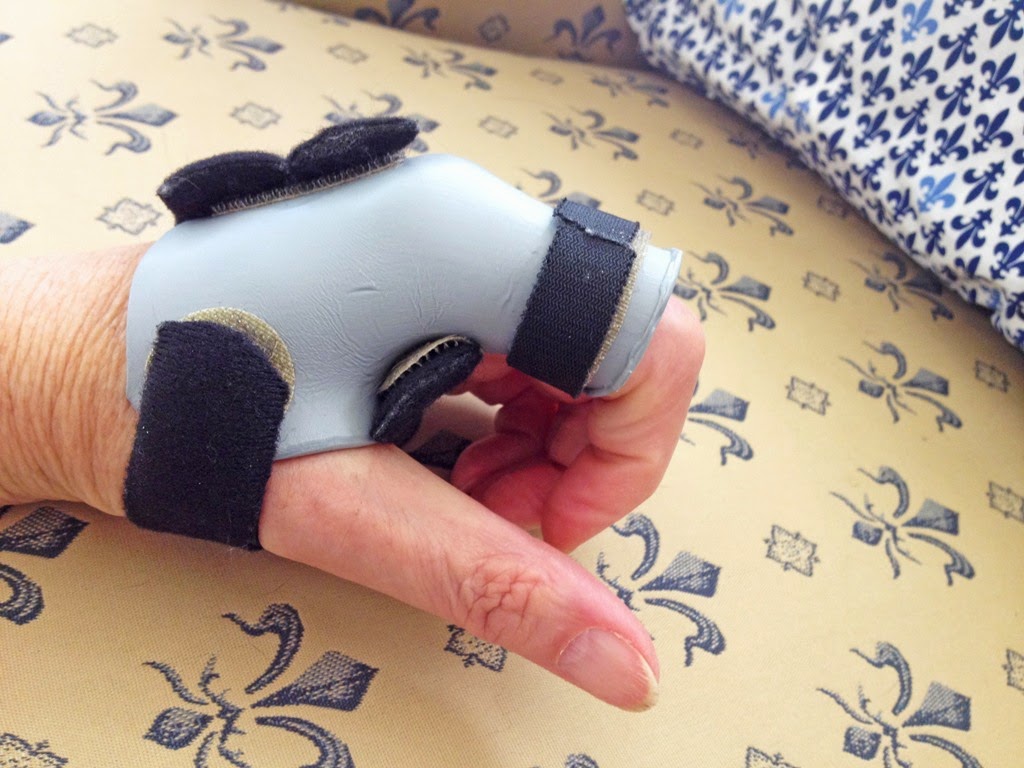 MARIETTE'S BACK TO BASICS {My Hand with Dupuytren's Contracture Update}