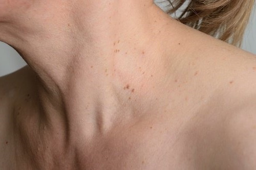remedios naturales para quitar verrugas del cuello