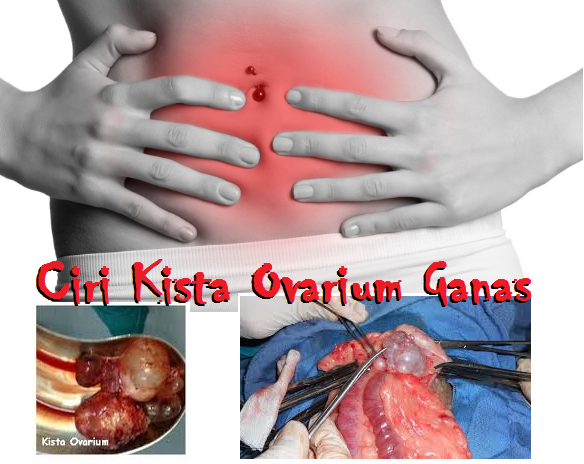 Apa Itu Kista? Berikut Ciri-Ciri, Penyebab dan Cara Alami Mengobati Kista Apa Itu Kista? Berikut Ciri-Ciri, Penyebab dan Cara Alami Mengobati Kista